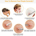 7-Pieces: Blackhead Remover Stainless Steel by DailySale