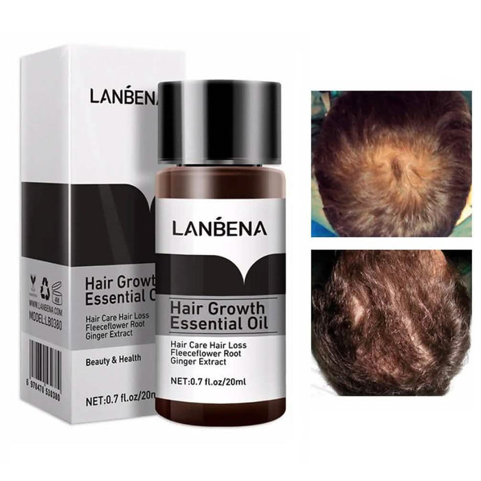 Essential Oil For Hair Growth And Hair Loss Treatment For Men And Women by DailySale