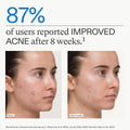 Nutrafol Clear Skin Nutraceutical Acne Supplement 3-Month Supply by Nava Beauty