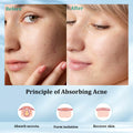 SHIVRISE Pimple Patch Hydrocolloid Acne Spot Cover Tea Tree Oil 36 Count by Deal US