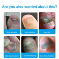 Toenail Fungus Treatment Extra Strength Nail Repair Foot Care by Deal US