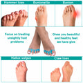 NAMELESS NICHE Toe Separators Bunion Corrector Toe Spacers Pink 1 Pair by Deal US