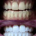 TrueWhite Advanced Plus 2 Person Whitening System by DailySale