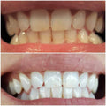 TrueWhite Advanced Plus 2 Person Whitening System by DailySale